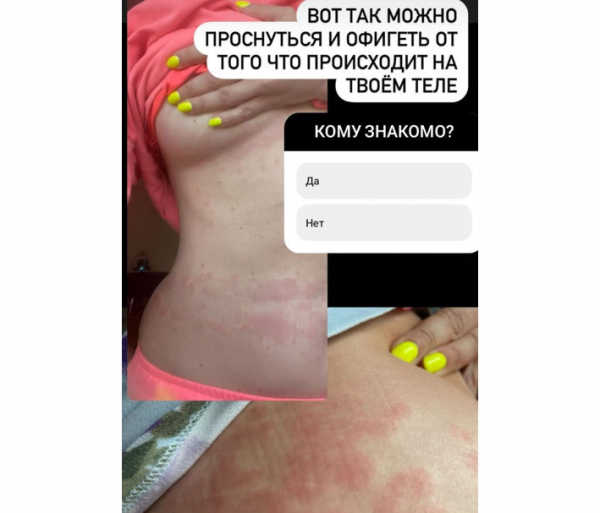 Наташа Королева показала свое тело во время аллергии: «Фото не для слабонервных!»